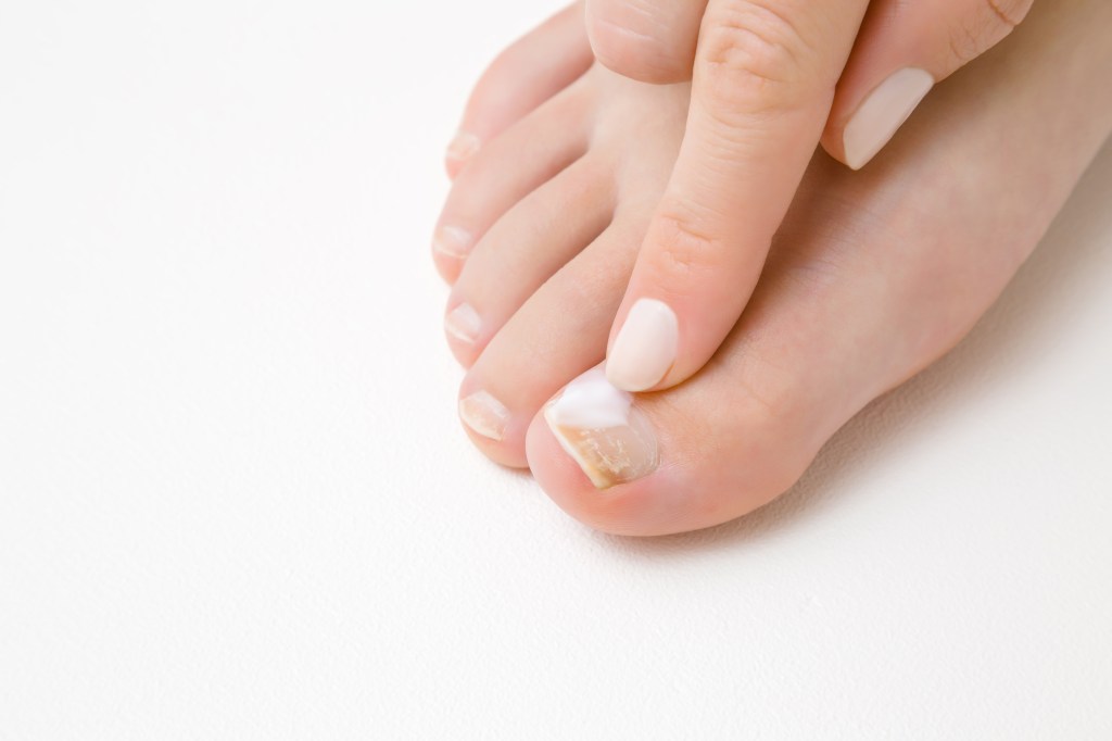 Because nails—especially toenails—grow slowly, treatment tends to be expensive and time-consuming. Here, a woman tells about the fungus on her big toenail.