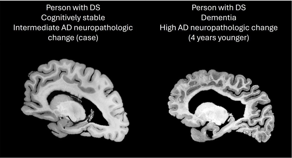Brain comparisons of two people with Daun syndrome, with the person to the left with intermediate Alzheimer's disease and stable recognition.