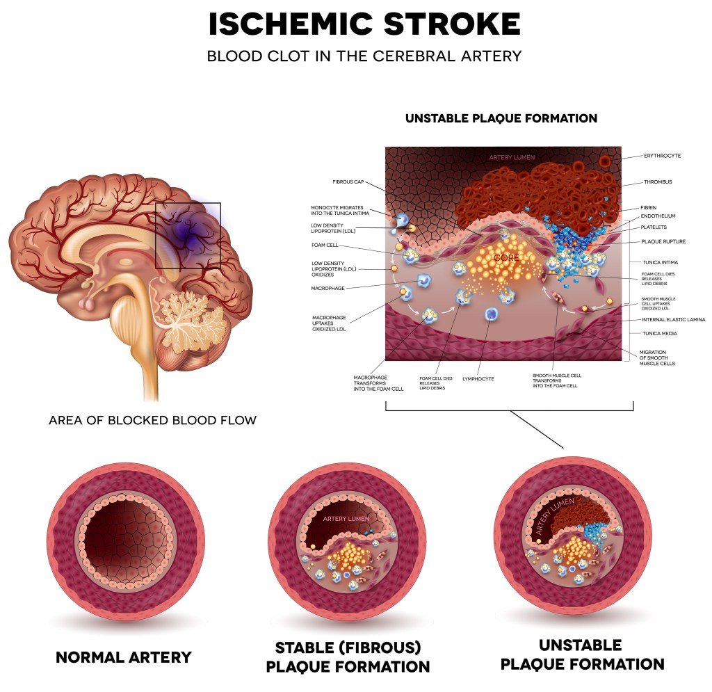 The diagram shows how the blocked causes of the blood flow causes ischemic stroke.
