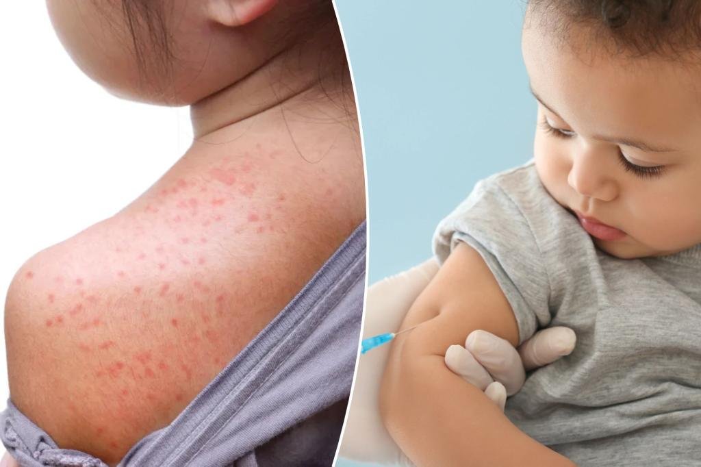Doc warns against the 70s tendency making a comeback between measles explosions