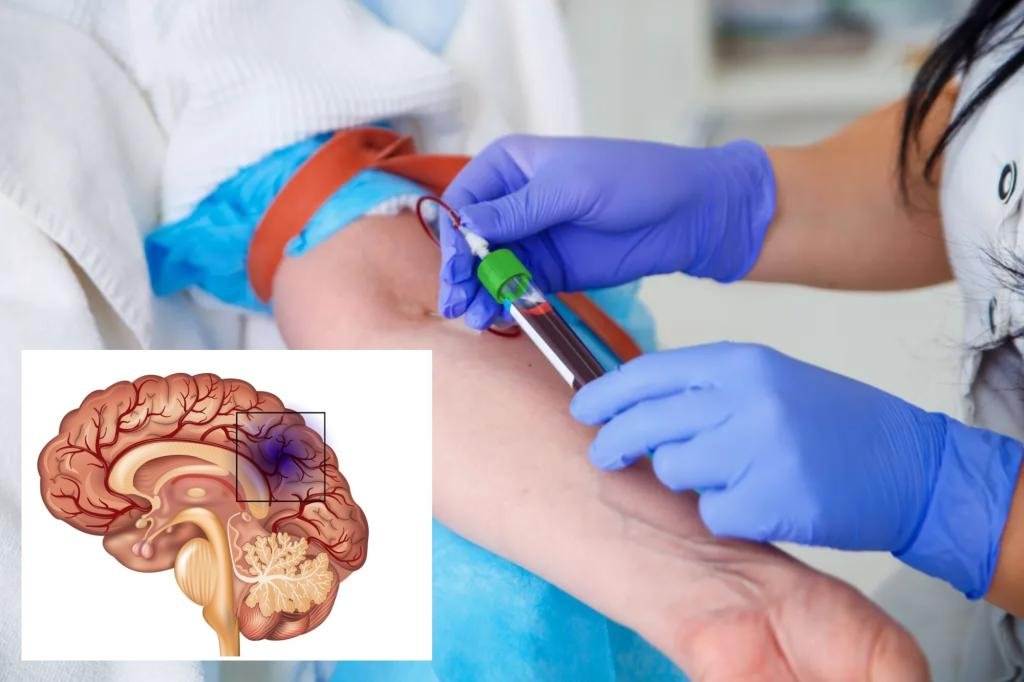 This type of blood increases the early risk of stroke by 16%